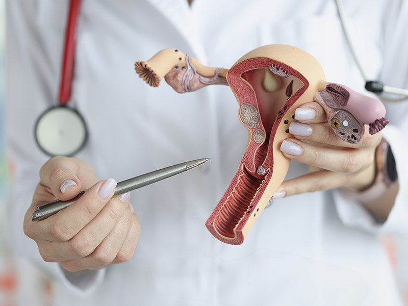 Tratamiento para endometriosis y síndrome de ovario poliquístico